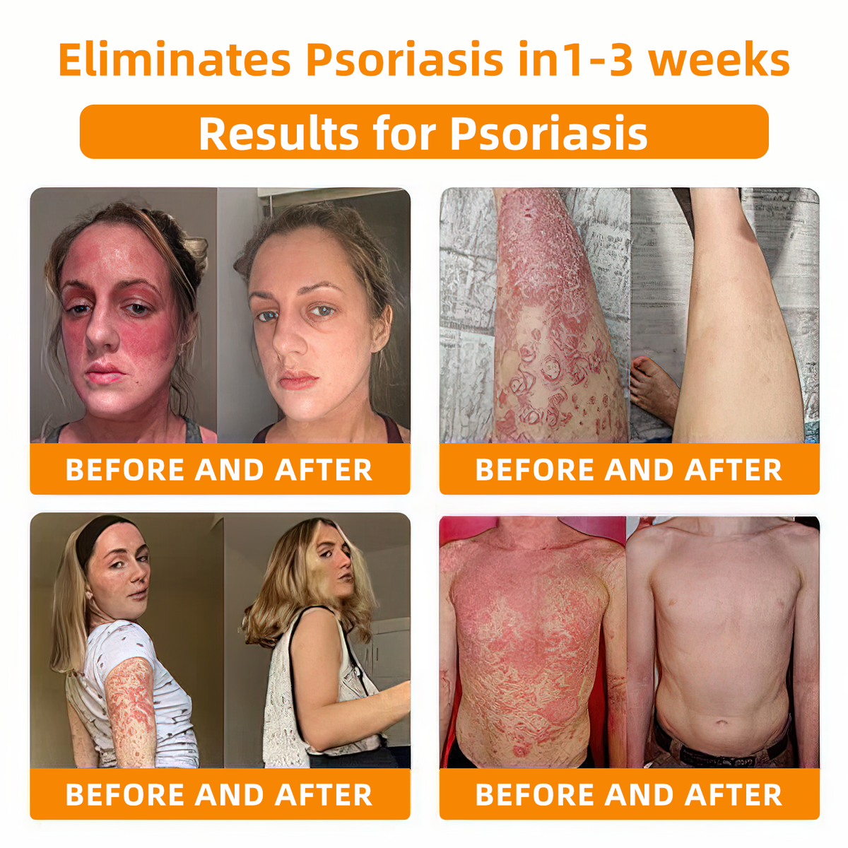 👩‍⚕️👩‍⚕️𝐙𝐨𝐞𝐧𝐜𝐠𝐳™ 𝐁𝐞𝐞 𝐕𝐞𝐧𝐨𝐦 𝐏𝐬𝐨𝐫𝐢𝐚𝐬𝐢𝐬 𝐑𝐞𝐥𝐢𝐞𝐟 𝐀𝐧𝐭𝐢𝐛𝐚𝐜𝐭𝐞𝐫𝐢𝐚𝐥 𝐂𝐫𝐞𝐚𝐦 (🏅𝐀𝐂𝐃 𝐑𝐞𝐜𝐨𝐦𝐦𝐞𝐧𝐝𝐞𝐝🏅)
