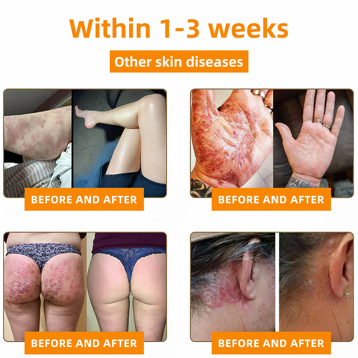 👩‍⚕️👩‍⚕️𝐙𝐨𝐞𝐧𝐜𝐠𝐳™ 𝐁𝐞𝐞 𝐕𝐞𝐧𝐨𝐦 𝐏𝐬𝐨𝐫𝐢𝐚𝐬𝐢𝐬 𝐑𝐞𝐥𝐢𝐞𝐟 𝐀𝐧𝐭𝐢𝐛𝐚𝐜𝐭𝐞𝐫𝐢𝐚𝐥 𝐂𝐫𝐞𝐚𝐦 (🏅𝐀𝐂𝐃 𝐑𝐞𝐜𝐨𝐦𝐦𝐞𝐧𝐝𝐞𝐝🏅)