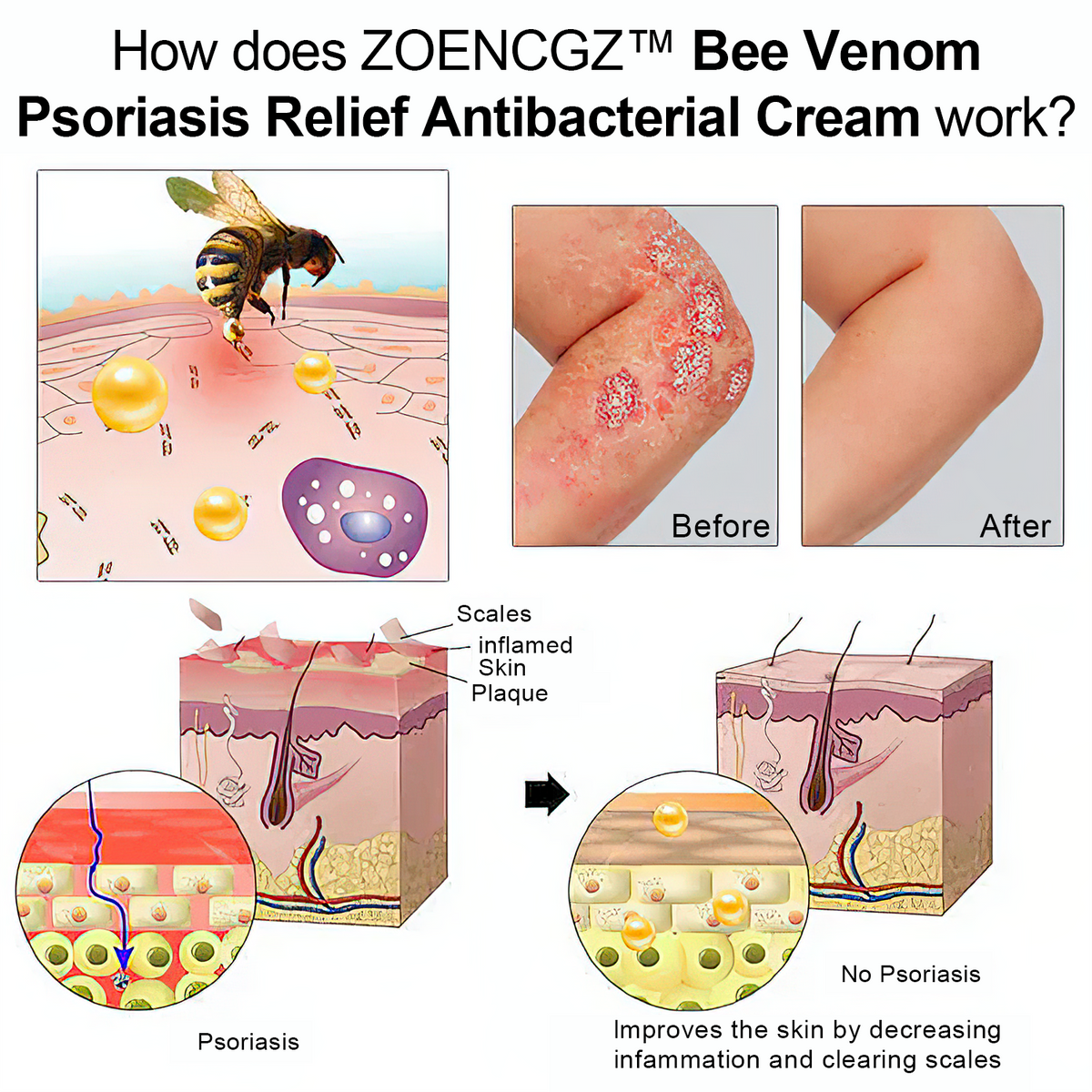👩‍⚕️👩‍⚕️𝐙𝐨𝐞𝐧𝐜𝐠𝐳™ 𝐁𝐞𝐞 𝐕𝐞𝐧𝐨𝐦 𝐏𝐬𝐨𝐫𝐢𝐚𝐬𝐢𝐬 𝐑𝐞𝐥𝐢𝐞𝐟 𝐀𝐧𝐭𝐢𝐛𝐚𝐜𝐭𝐞𝐫𝐢𝐚𝐥 𝐂𝐫𝐞𝐚𝐦 (🏅𝐀𝐂𝐃 𝐑𝐞𝐜𝐨𝐦𝐦𝐞𝐧𝐝𝐞𝐝🏅)