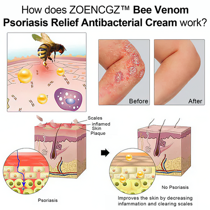 👩‍⚕️👩‍⚕️𝐙𝐨𝐞𝐧𝐜𝐠𝐳™ 𝐁𝐞𝐞 𝐕𝐞𝐧𝐨𝐦 𝐏𝐬𝐨𝐫𝐢𝐚𝐬𝐢𝐬 𝐑𝐞𝐥𝐢𝐞𝐟 𝐀𝐧𝐭𝐢𝐛𝐚𝐜𝐭𝐞𝐫𝐢𝐚𝐥 𝐂𝐫𝐞𝐚𝐦 (🏅𝐀𝐂𝐃 𝐑𝐞𝐜𝐨𝐦𝐦𝐞𝐧𝐝𝐞𝐝🏅)